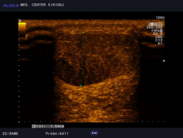 Ultrazvok Ahilove tetive - tendinoza, prečno, indikacija ESWT 4